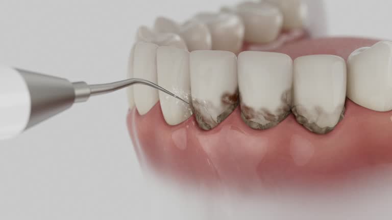 Trusted Wisdom Tooth Removal service in Penngrove, CA - Dentist Open Now